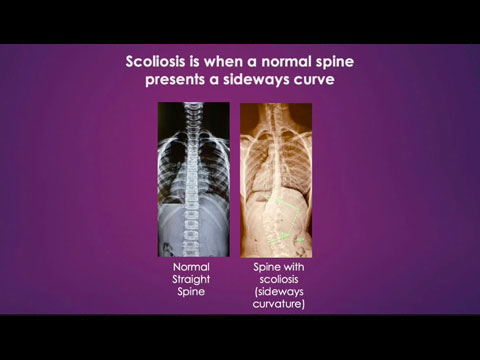 Marta Eliza Miller Foundation Scoliosis Awareness Video